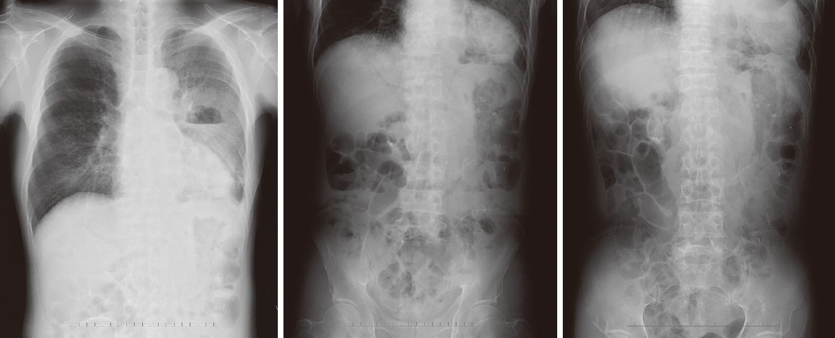 ⓔ図10-16-5　横隔膜膿瘍胸部X線写真 65歳男性，左横隔膜下膿瘍＋胸腔穿破 (左膿胸)，初診時． 【現病歴】慢性膵炎＋閉塞性黄疸で胆管空腸バイパス術後に12指腸狭窄をきたし，胃腔腸バイパス術施行．その後，12指腸皮膚瘻も発症し閉鎖術施行後．左横隔膜下膿瘍＋胸腔穿破による左膿胸を発症．