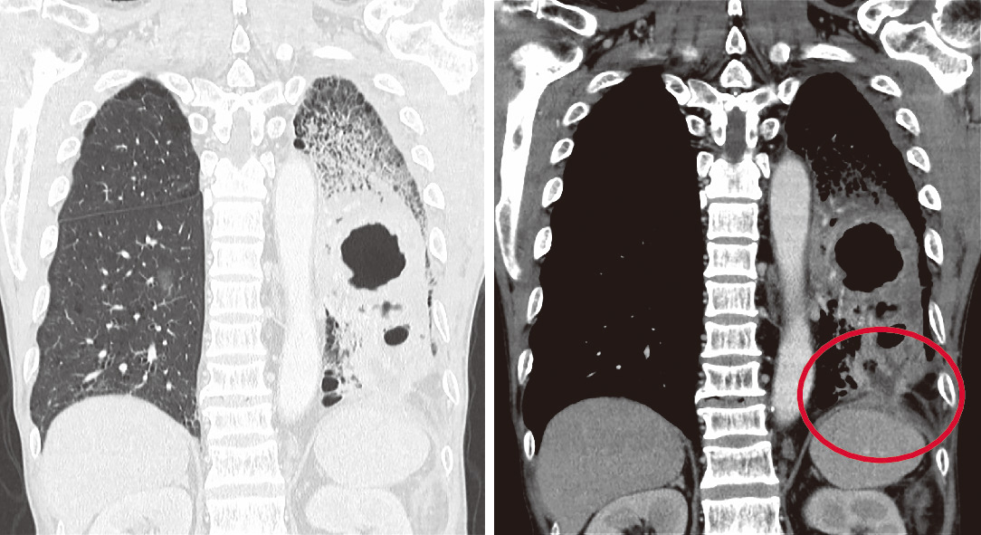 ⓔ図10-16-6　横隔膜膿腫胸部CT画像 (冠状断像) 〇は横隔膜下膿瘍の胸腔穿破所見．