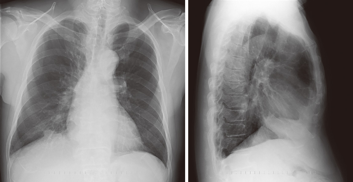 ⓔ図10-16-7　横隔膜腫瘍胸部X線写真 74歳男性，右下葉粘表皮癌，初診時．