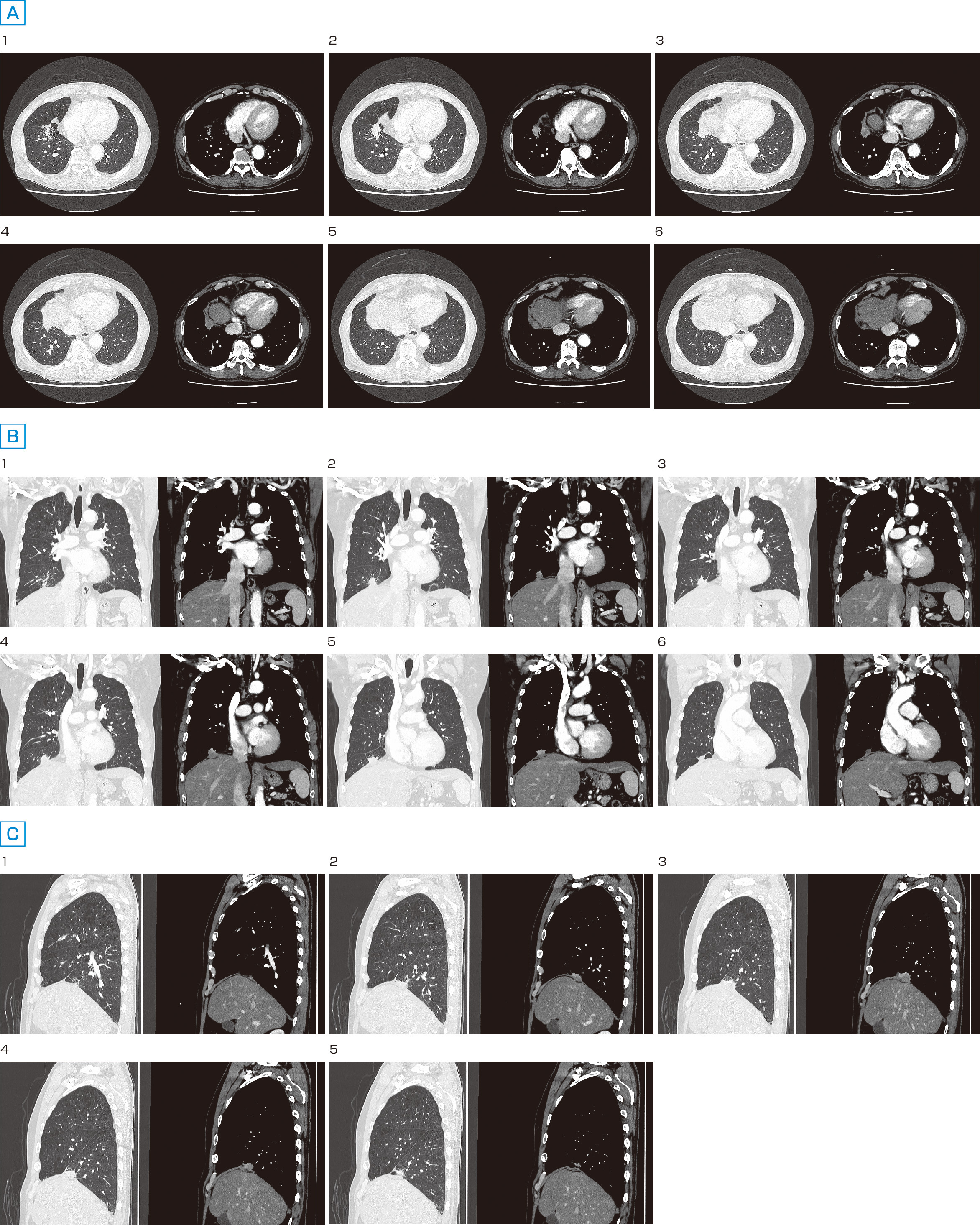 ⓔ図10-16-8　横隔膜膿腫胸部CT画像 右下葉肺癌，粘表皮癌pT4 (Dia) N0M0 pStageⅢA，初診時 A：水平断像，B：冠状断像，C：矢状断像