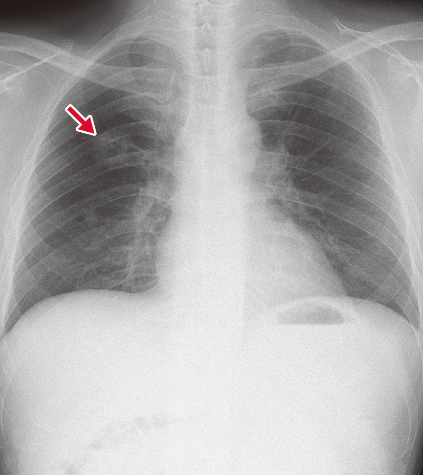 ⓔ図10-2-9　肺ムーコル症の胸部X線写真 