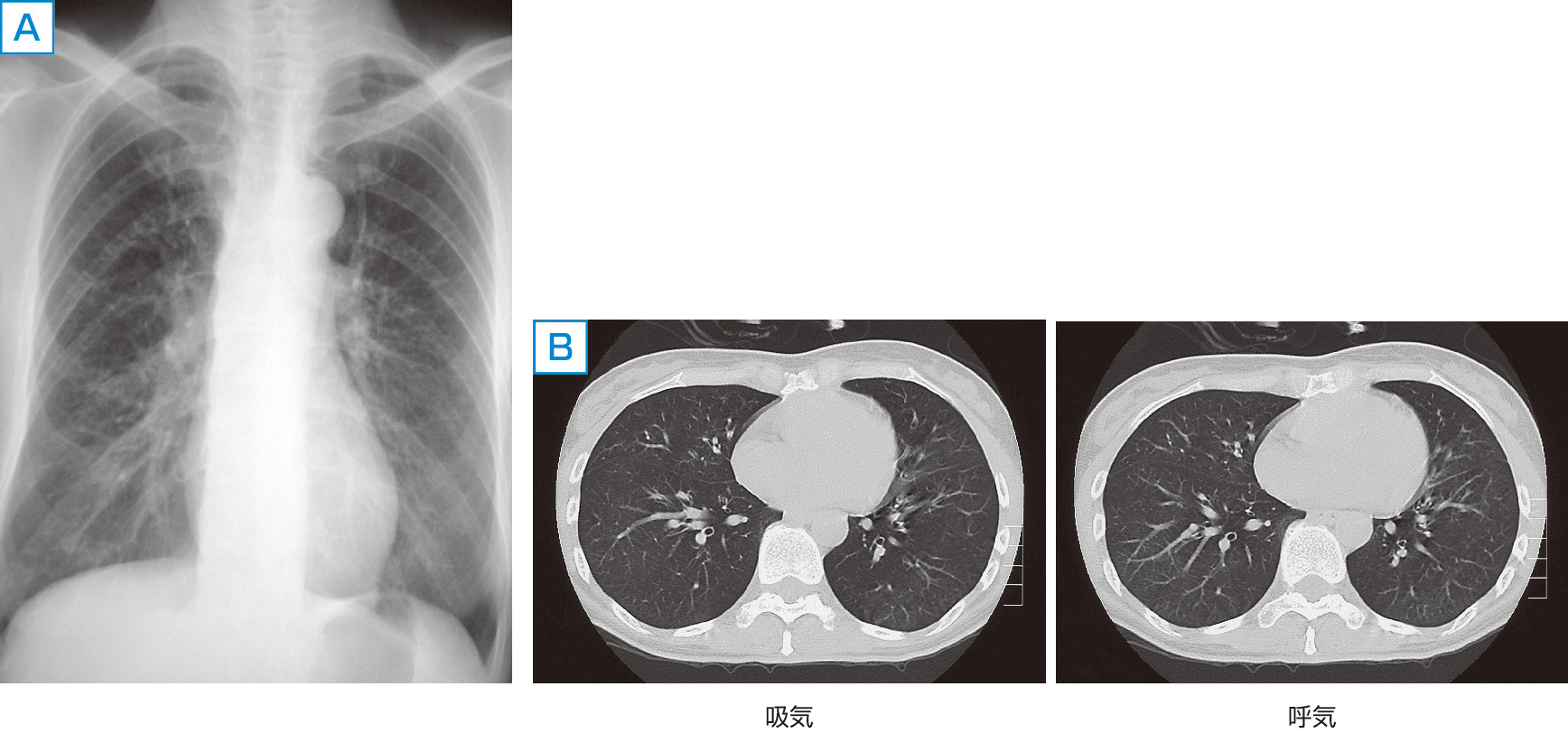 ⓔ図10-3-3　BOの画像所見 A：BOの胸部X線像．ほぼ正常か，わずかに過膨張を示す． B：BOの吸気・呼気相での胸部HRCT像．呼気相HRCTでの空気とらえ込み現象がわずかに認められる．