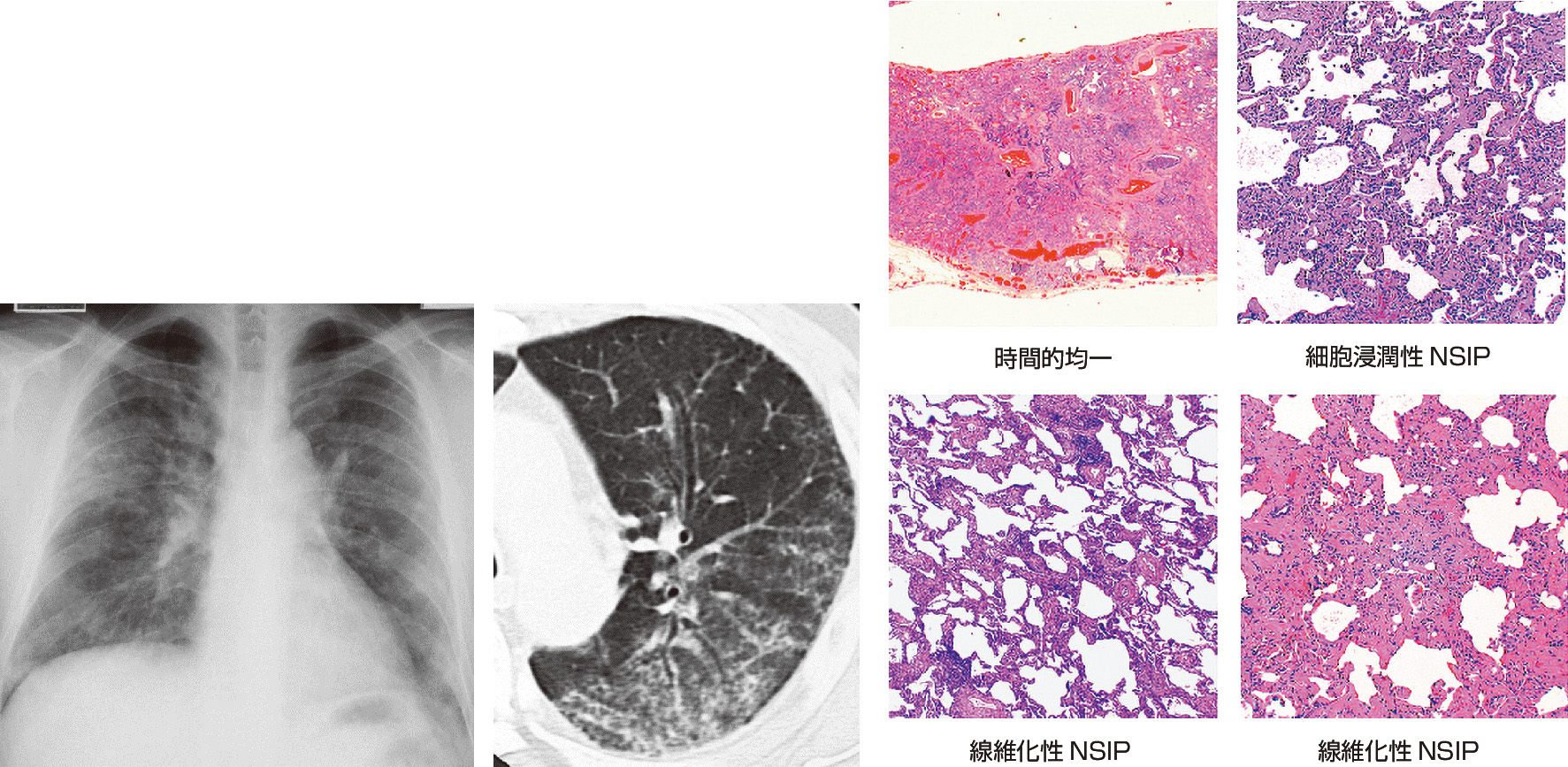 ⓔ図10-5-2　NSIP/NSIPの画像と病理所見 (福岡順也：臨床画像，2004; 20: 6–15より作成) 両側肺野にすりガラス，網状影，牽引性気管支拡張が認められる．病理像は小葉内にびまん性に分布し，細胞浸潤性NSIPでは間質にリンパ球，形質細胞がびまん性に浸潤する．線維化性NSIPではびまん性に時相の一致した線維化が認められる．