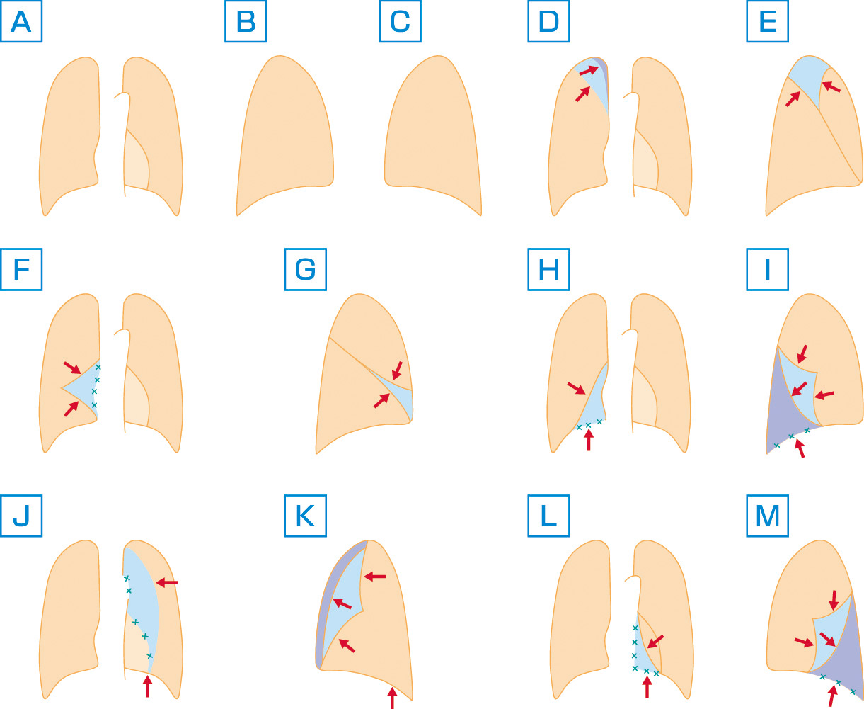 ⓔ図10-7-1　各肺葉無気肺の胸部単純X線所見 (模式図) A：正常正面，B：正常側面 (右肺)，C：正常側面 (左肺)，D：右肺上葉無気肺 (正面)，E：右肺上葉無気肺 (側面)，F：右肺中葉無気肺 (正面)，G：右肺中葉無気肺 (側面)，H：右肺下葉無気肺 (正面)，I：右肺下葉無気肺 (側面)，J：左肺上葉無気肺 (正面)，K：左肺上葉無気肺 (側面)，L：左肺下葉無気肺 (正面)，M：左肺下葉無気肺 (側面). 水色→青色は無気肺の進行を表す．赤矢印は偏位を示す．水色の x 印はシルエットの不鮮明化 (シルエットサイン陽性) を示す．