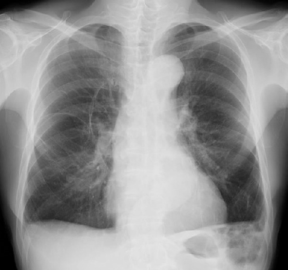 ⓔ図10-9-2　Birt–Hogg–Dubé症候群患者の胸部単純X線写真 70歳代男性．肺野に多発嚢胞が観察されている．遺伝子検査においてFLCN遺伝子変異が確認された．