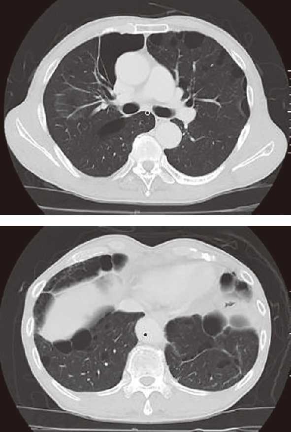 ⓔ図10-9-3　Birt–Hogg–Dubé症候群患者の胸部CT画像 症例の胸部CT画像 (肺野条件)．肺底部と縦郭側胸膜に接する多発肺嚢胞が観察された．