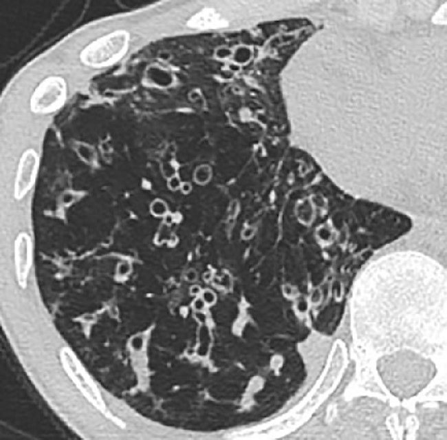 ⓔ図10-9-6　気管支拡張の付随所見 気管支拡張の多彩な付随所見を認める (壁肥厚，粘液栓，無気肺，気腫性変化，粒状陰影)．