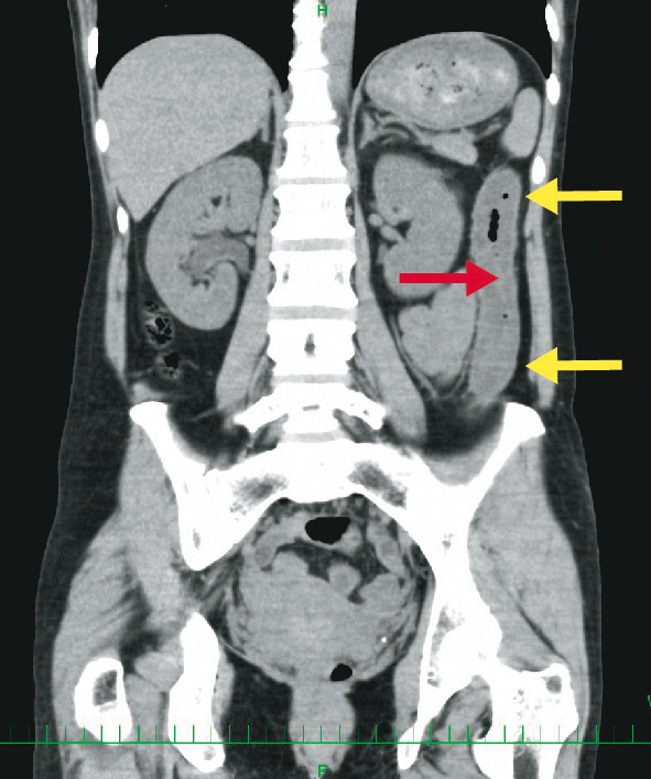 ⓔ図11-1-5　虚血性腸炎症例 (単純CT) 結腸脾弯曲部からS状結腸まで連続性に腸管壁の浮腫がみられる (黄色矢印)．腸管ガスは内腔側に偏位している．このガス像から尾側に細い高吸収な構造が連続しており，粘膜に相当する．腸管壁肥厚の主体は粘膜下の高度な浮腫であることがわかる (赤矢印)．