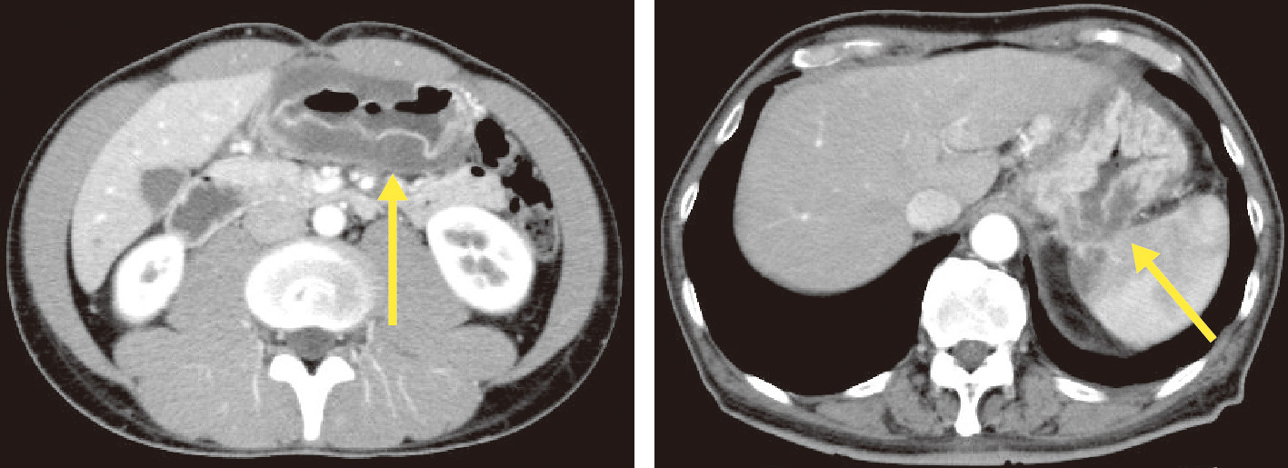 ⓔ図11-1-6　造影CT どちらの症例でも胃壁に浮腫状に見える壁肥厚を認めるが，左はAGML (症状は急性の上腹部痛)，右は粘液産生性胃癌 (症状はやや経過の長い背部痛) であった．