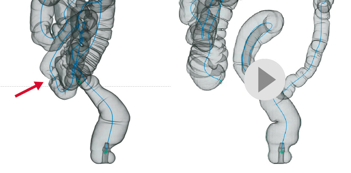 ⓔ図11-1-7　CT colonoscopy (仮想注腸画像) S状結腸癌．左が病変部，右は回転動画 (ⓔ動画11-1-21)．