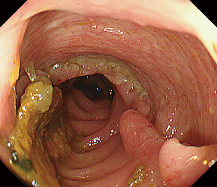 ⓔ図11-10-1　好酸球性多発血管炎性肉芽腫症 (EGPA) の内視鏡像 大腸内視鏡検査にて横行結腸に巨大な深い潰瘍を形成していた．