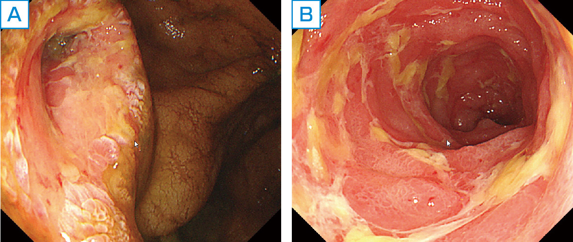 ⓔ図11-10-3　移植片対宿主病の内視鏡像 A：回盲弁は全体に浮腫状で地図状のびらんを認める． B：回腸終末部も浮腫状で多数のびらんを認める．