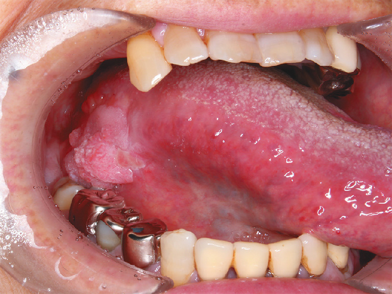 ⓔ図11-2-1　早期舌癌 舌縁に顆粒と白斑を認める．