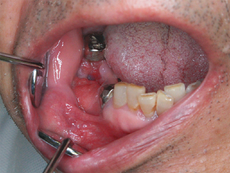 ⓔ図11-2-2　下顎歯肉癌 歯周炎と診断され抜歯後の口腔内写真．