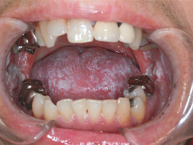 ⓔ図11-2-4　口腔カンジダ症 