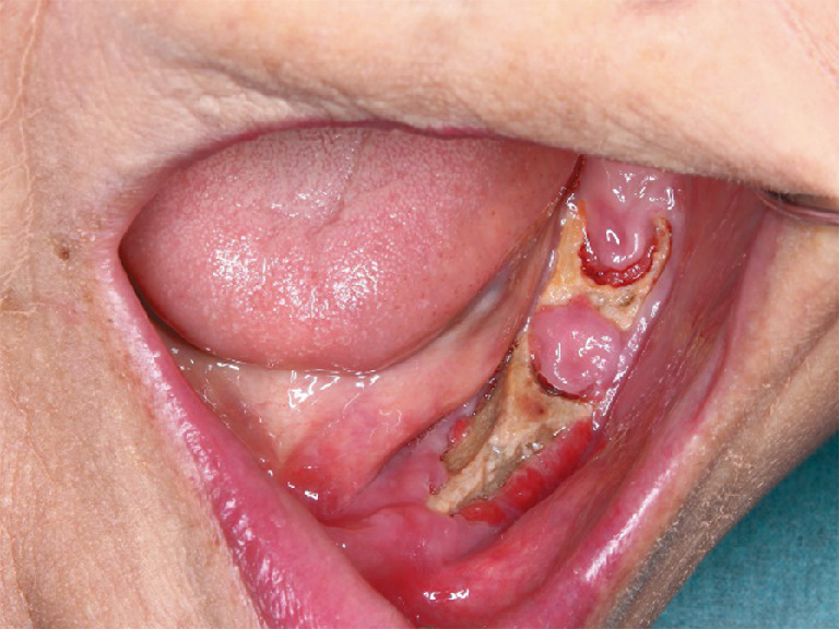 ⓔ図11-2-5　薬剤関連性顎骨壊死 