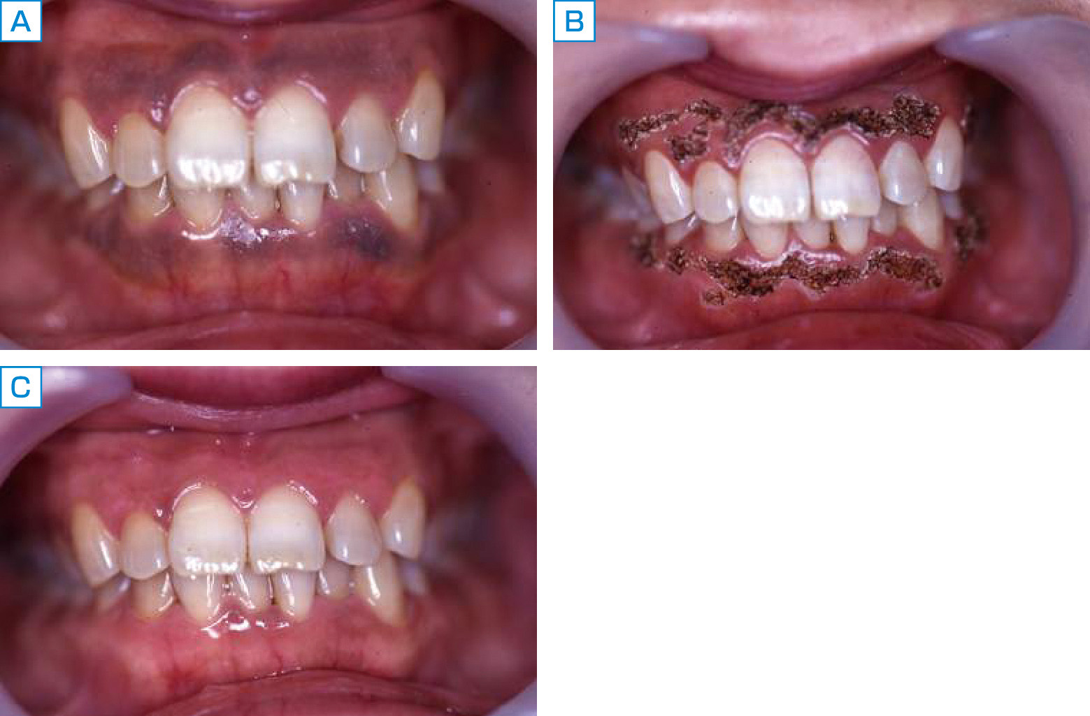 ⓔ図11-2-8　メラニン色素沈着症 A：照射前，B：照射直後，C：照射後2週間．
