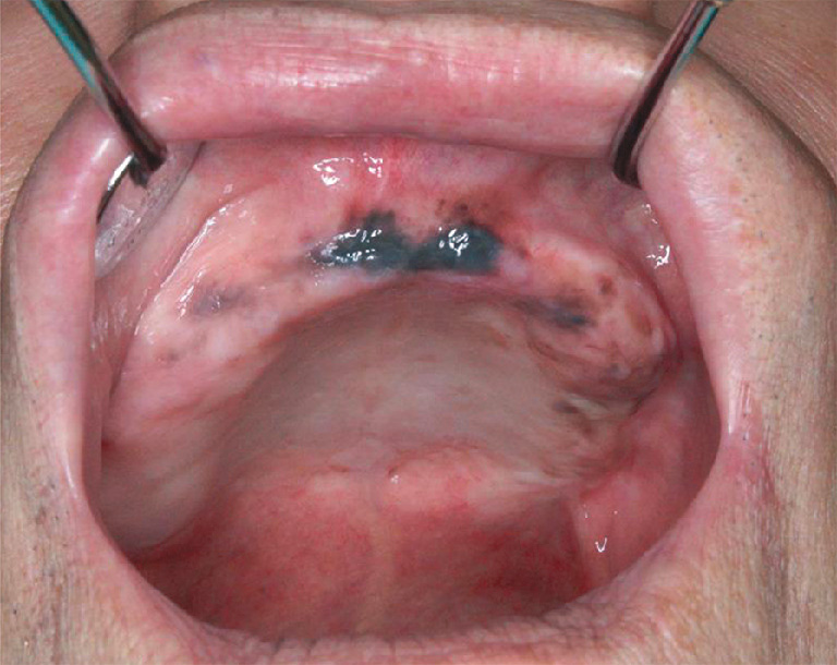 ⓔ図11-2-9　悪性黒色腫 メラニン色素沈着症との診断で長期経過観察していたところ，上皮内黒色腫 (melanoma in situ) に転化した症例の口腔内写真．