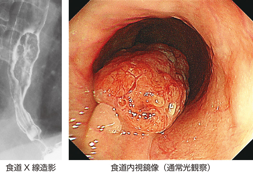 ⓔ図11-3-10　胸部中部食道の類基底細胞癌 