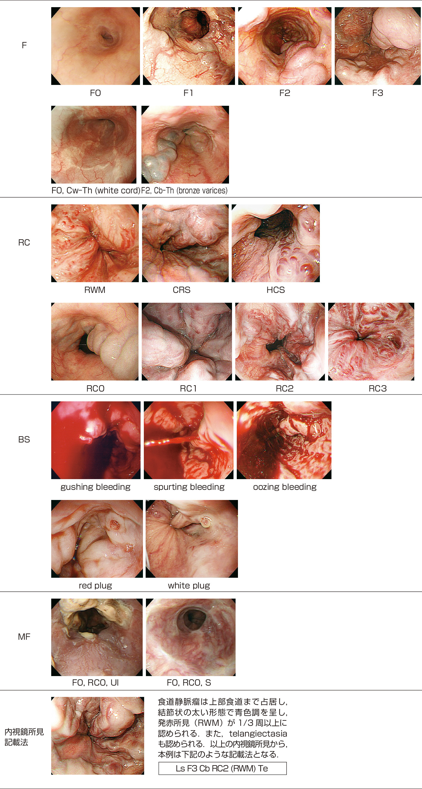 ⓔ図11-3-15　食道静脈瘤の代表的な内視鏡所見 (F, RC, BS, MF) 