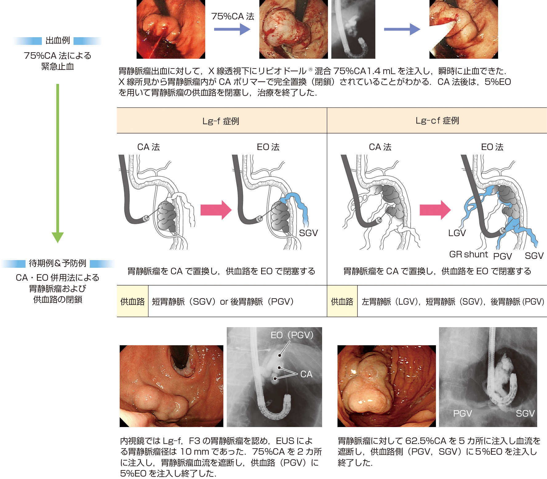 ⓔ図11-3-18　胃静脈瘤に対する内視鏡治療の手技 