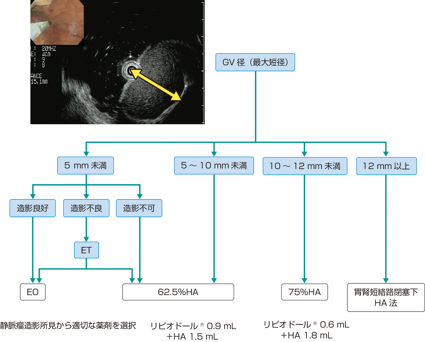 ⓔ図11-3-19　EUSによるGV径からみた治療法の選択 