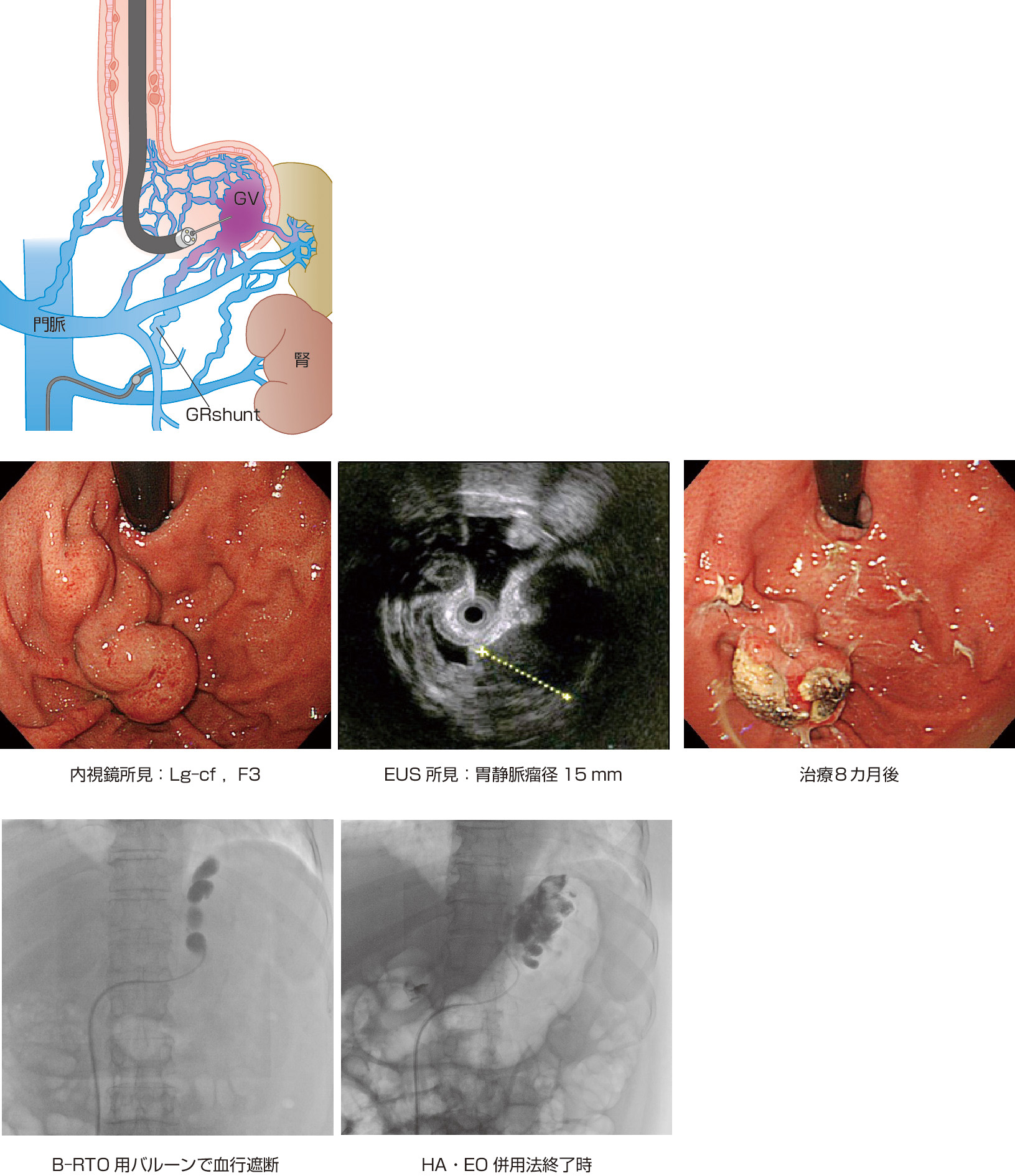 ⓔ図11-3-20　腎静脈系短絡路閉塞下HA法の手技 腎静脈系短絡路 (GR shunt) をB–RTO用バルーンカテーテルで血流を遮断しながら，内視鏡的に75％HAを胃静脈瘤内に注入する．