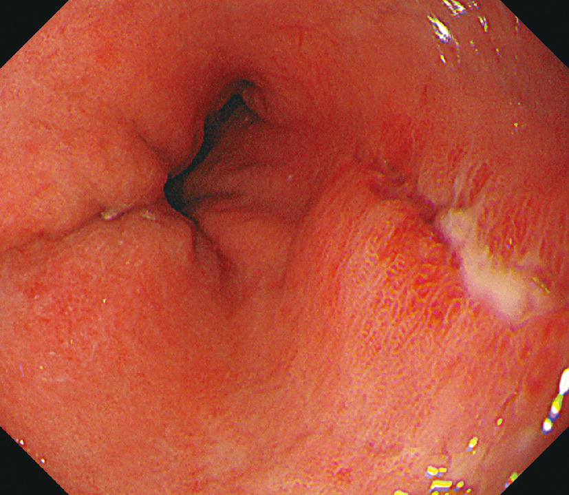 ⓔ図11-3-3　食道胃接合部の線状びらん・潰瘍 潰瘍辺縁はやや不整で発赤を伴う．