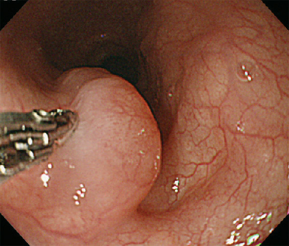 ⓔ図11-3-9　平滑筋腫 鉗子による圧迫でcushion signは陰性で，可動性も不良なため筋層由来の高い病変を考える．