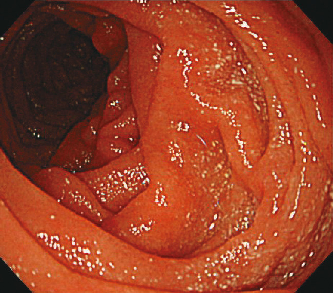 ⓔ図11-4-11　十二指腸濾胞性リンパ腫 下降部に集簇した白色調の顆粒状病変を認める．