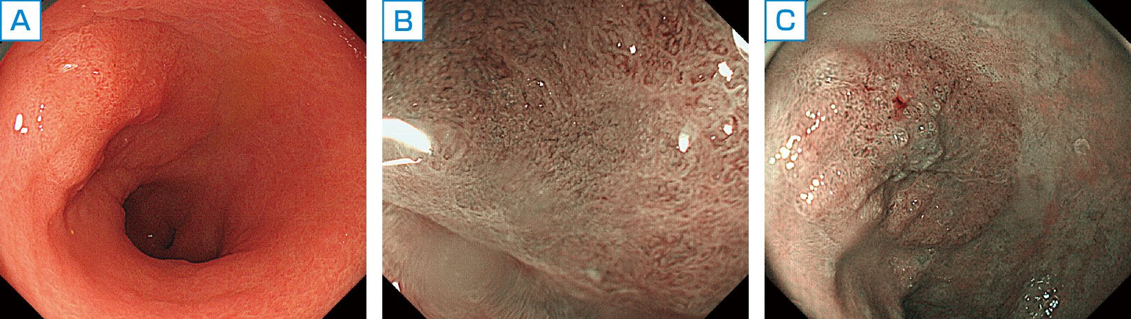 ⓔ図11-4-3　0–Ⅱa型早期胃癌 A：前庭部小弯に浅い隆起がみられる． B：NBI観察像． C：拡大NBI観察では，癌表面の微小血管不整，微小構造不整が認められる．