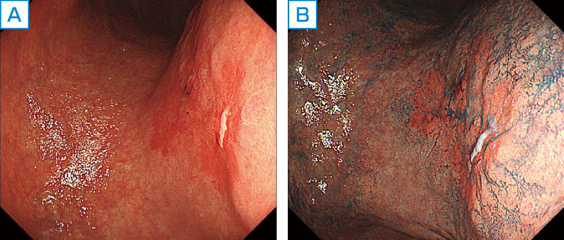ⓔ図11-4-4　0–Ⅱb型早期胃癌 A：体下部後壁の0–Ⅱb型早期胃癌．隆起，陥凹に乏しく不整な発赤を認める． B：インジゴカルミン散布像．隆起陥凹は目立たない．