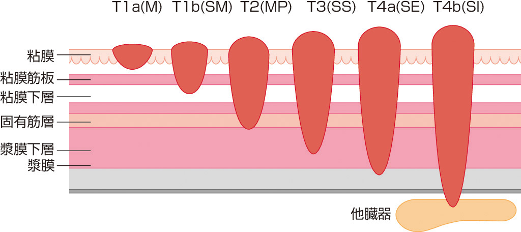 ⓔ図11-4-5　深達度による分類 胃壁の各層 (粘膜筋板を含む粘膜，粘膜下組織，固有筋層，漿膜下層，漿膜) のどこまで腫瘍が浸潤しているかでT分類が決定される．
