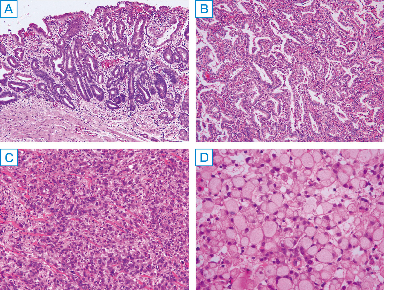 分化型甲状腺がんにはどのような種類がありますか?