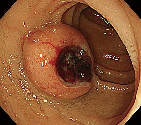ⓔ図11-4-9　十二指腸GIST (gastrointestinal stromal tumor) 緊満感のある粘膜下腫瘍を認める．周囲は正常粘膜に覆われ，中心に潰瘍を伴う．