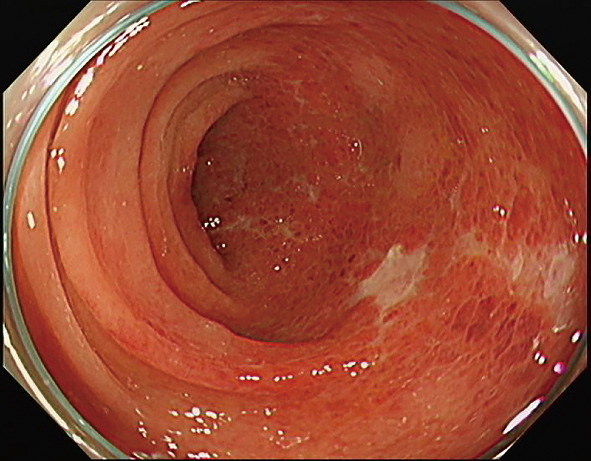 ⓔ図11-5-10　下行結腸内視鏡像 (3) 粘膜の半周程度，発赤した粘膜を認め，うろこ状の充血した粘膜が縦走配列している．一部びらん化しており同様に縦走配列している．