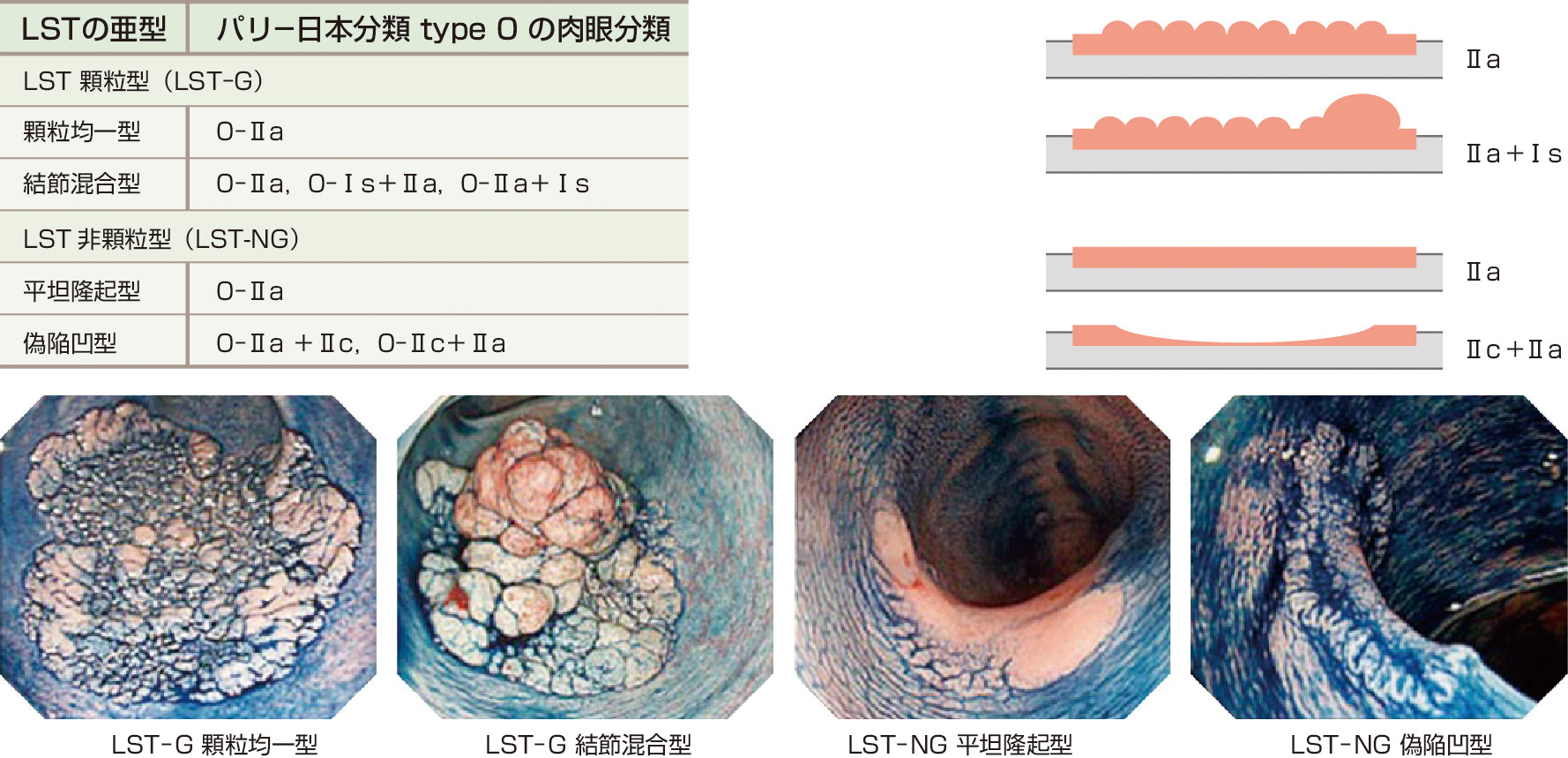 ⓔ図11-5-11　LSTの亜型：肉眼分類との対比 (パリ–日本による) (Kudo S, Lawbert R, et al：Gastrointest Endose，2008; 68: S3–47) 