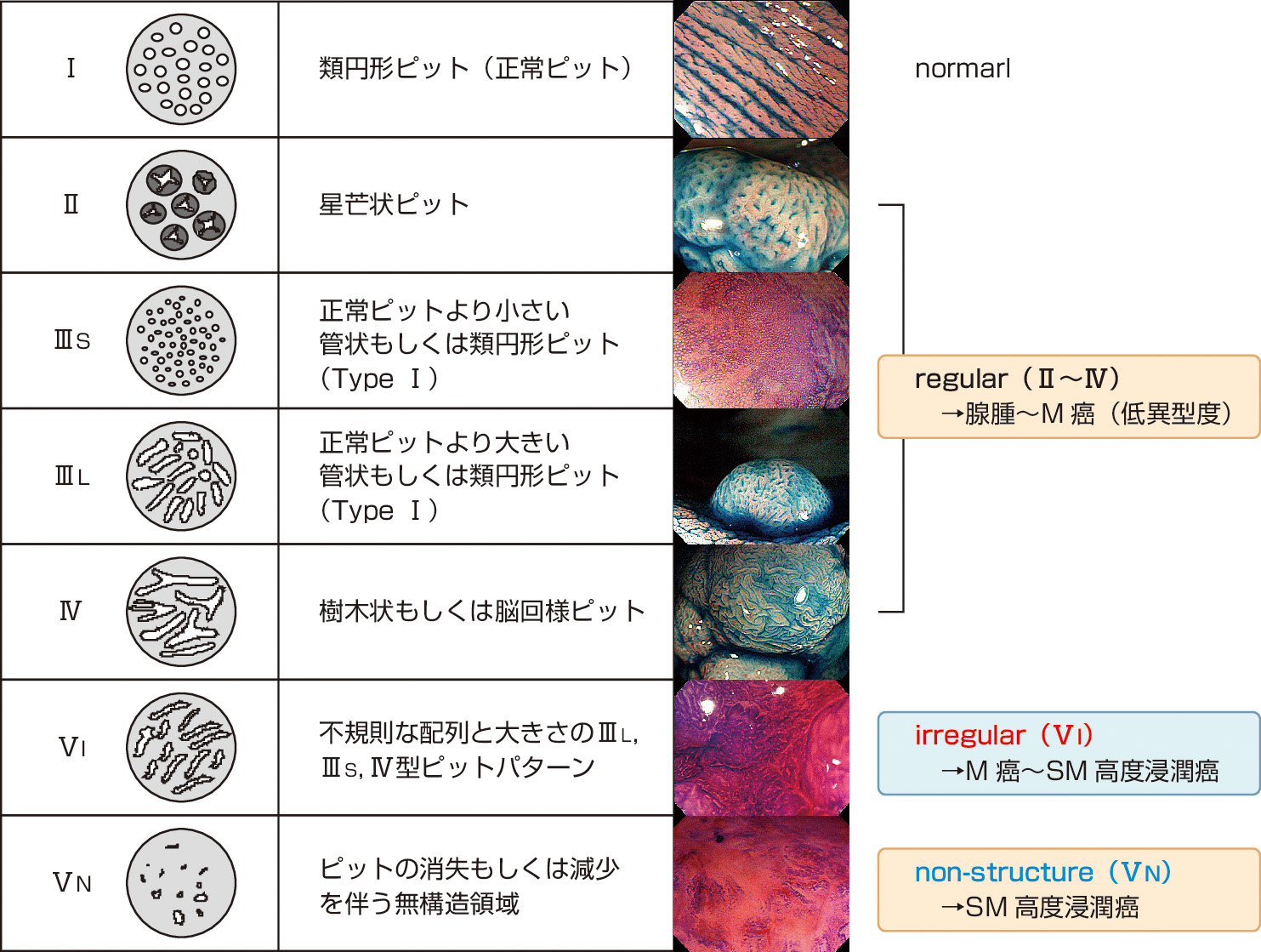 ⓔ図11-5-12　大腸腫瘍のピットパターン分類 (工藤・鶴田2001，2001) 