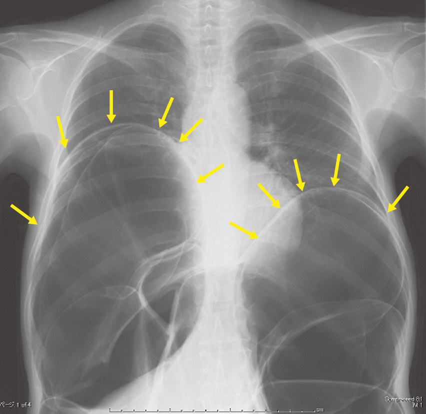ⓔ図11-5-14　CIPO患者のX線写真 胸部中央に至るほどの著明な腸管の拡張を認める．