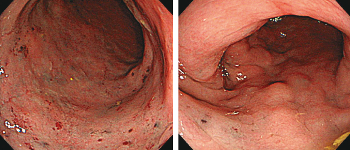 ⓔ図11-5-15　腹部造影CT軸位断 上腸間膜動脈の起始部からの造影不良を認める．