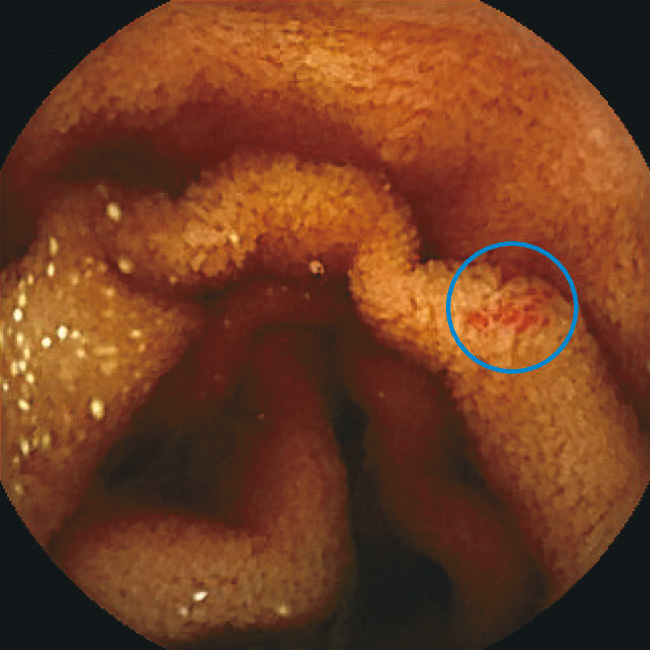 ⓔ図11-5-16　腹部造影CT冠状断 空腸から回腸末端まで全小腸の腸管壁造影不良と壁内気腫を認める．