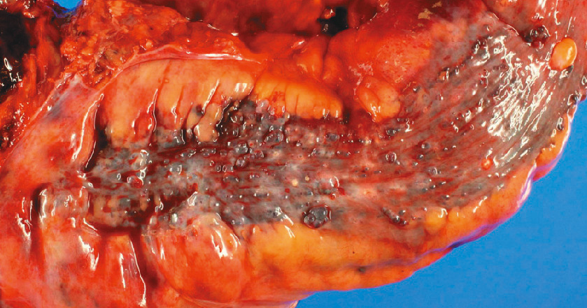 ⓔ図11-5-17　腹部造影CT立体構築像 上腸間膜動脈の起始部での高度狭窄を認める．