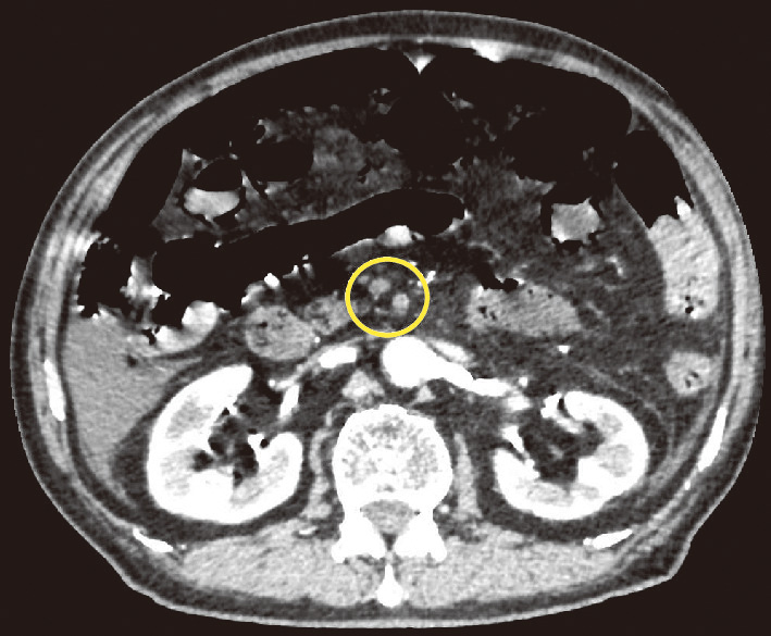 ⓔ図11-5-18　上腸間膜動脈閉塞のため切除された小腸 空腸および回腸の広範囲で虚血のため暗赤色に変色している．