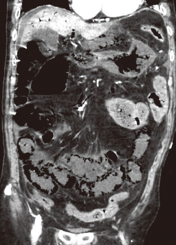 ⓔ図11-5-19　腹部造影CT冠状断 上腸間膜静脈，門脈内に血栓を認める．