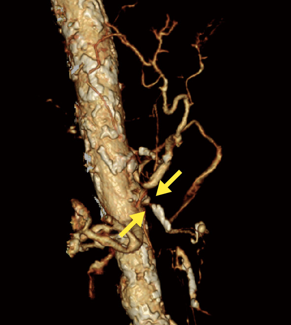 ⓔ図11-5-20　腹部造影CT立体構築像 上腸間膜静脈，門脈，脾静脈の広範囲に陰影欠損を認める．