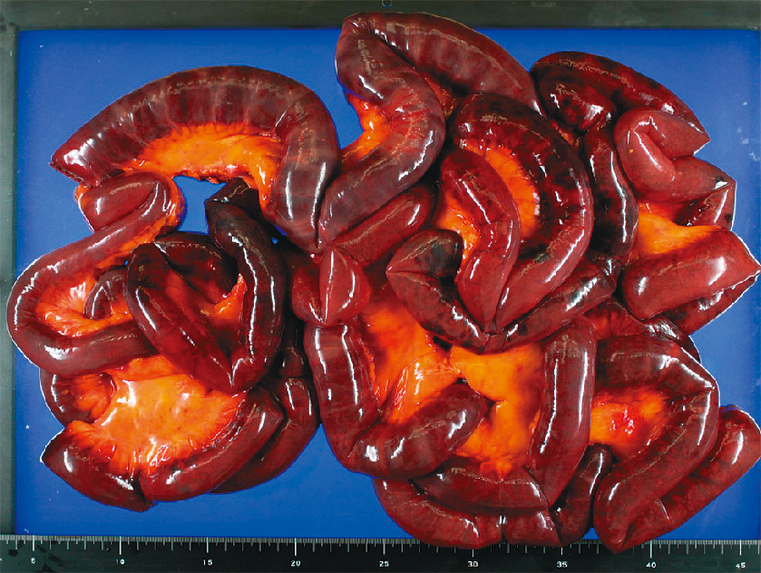 ⓔ図11-5-21　腹部造影CT軸位断 抗リン脂質抗体症候群で認めた門脈内血栓，腹腔動脈内血栓と脾梗塞．