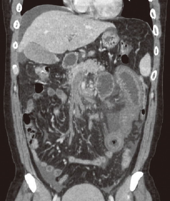 ⓔ図11-5-22　腹部造影CT軸位断 TAE後に認めた多発肝梗塞．