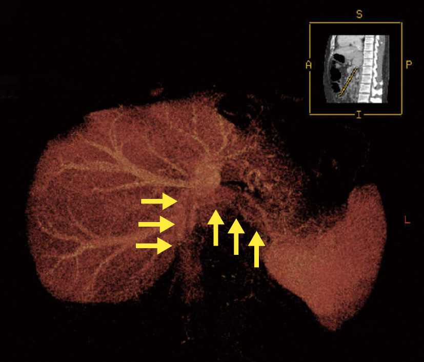 ⓔ図11-5-23　小腸カプセル内視鏡検査 CREST症候群の上部空腸に認めた血管拡張．