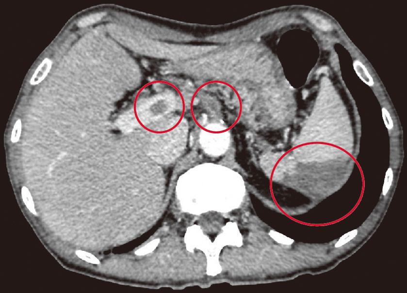 ⓔ図11-5-24　直腸動静脈奇形の下部消化管内視鏡所見 粘膜表面は発赤し，粘膜下に多発する暗赤色病変と粘膜下腫瘍様の隆起を認める．