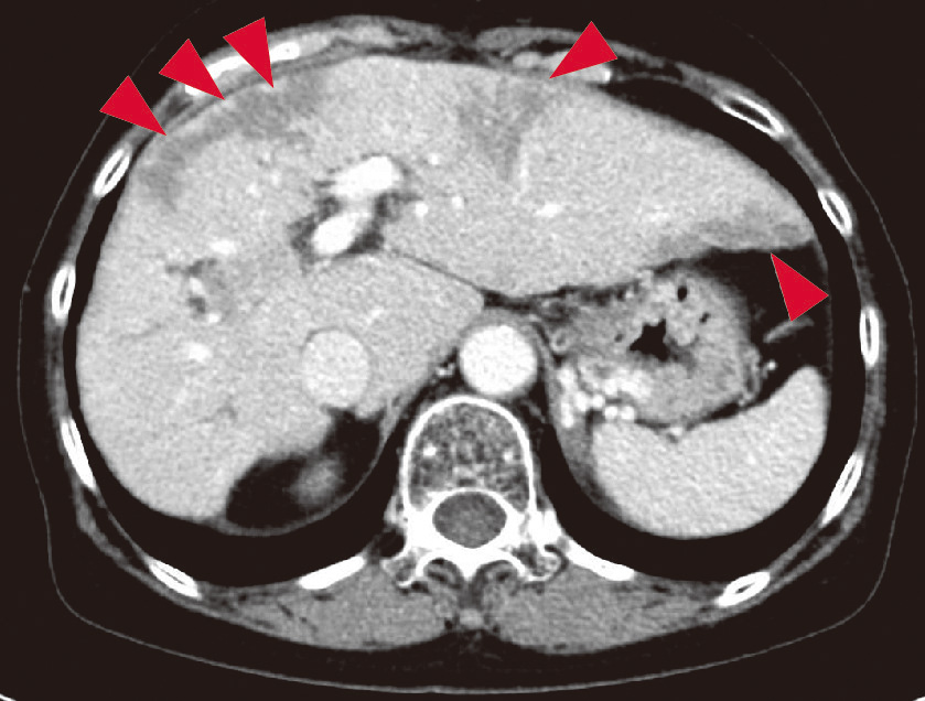 ⓔ図11-5-25　直腸動静脈奇形の直腸切除標本 暗赤色変化を伴う粘膜下腫瘍様隆起を認める．